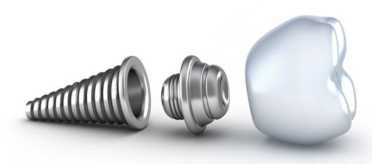 dr vahid ameli implant